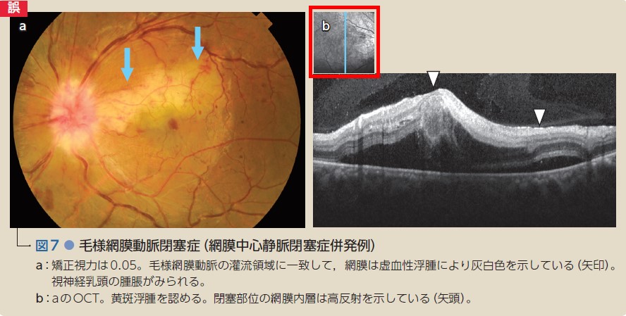 眼底図譜 カラーアトラス　【裁断済み】 カラーアトラス 眼底図譜 | 湯澤美都子, 川村昭之 |本 | 通販
